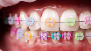 traitement d'orthodontie à Dubai